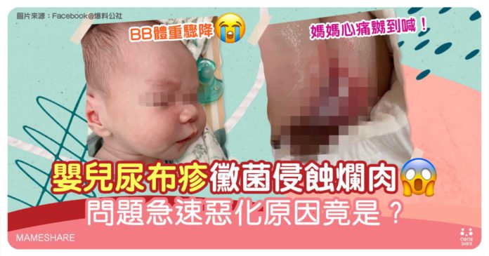 台嬰患尿布疹最嚴重第三級急停餵母乳-網友分享屁股見紅應對方法